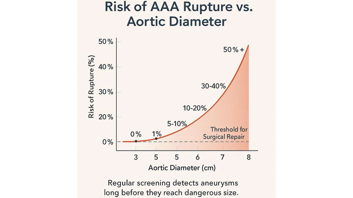AAA Risk — understanding abdominal aortic aneurysm symptoms, causes, and prevention