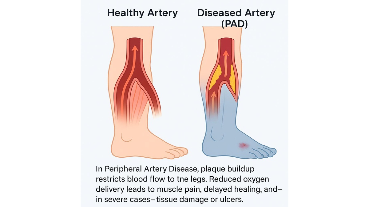 PAD comparison — peripheral artery disease symptoms, treatment, and prevention